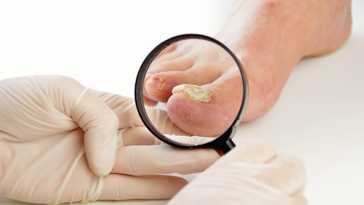 fungal-nail-infection