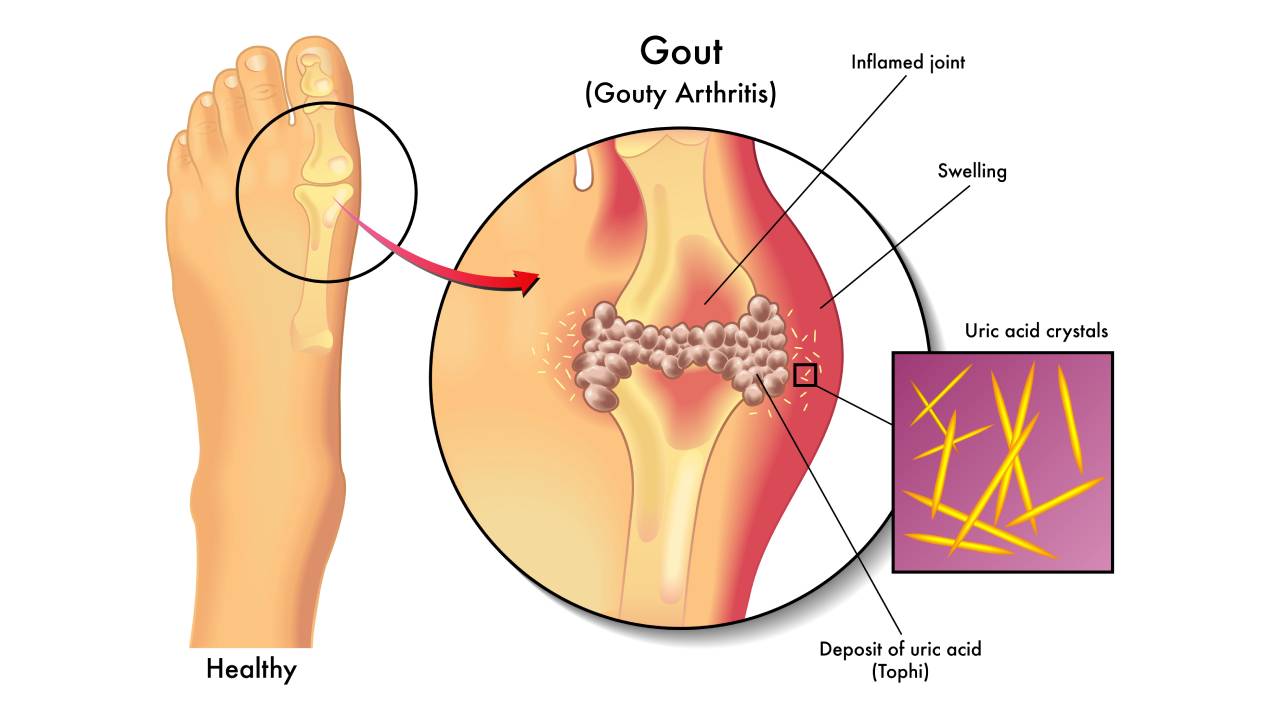 gout-uric-acid-crystals