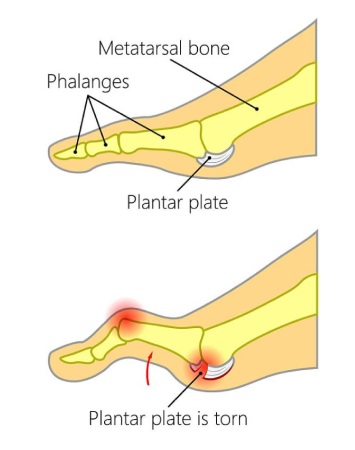 Plantar-Plate-Tear-2