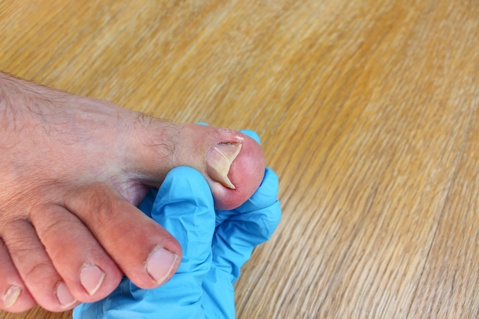 How Can A Podiatrist Help With Routine Nail and Skin Care