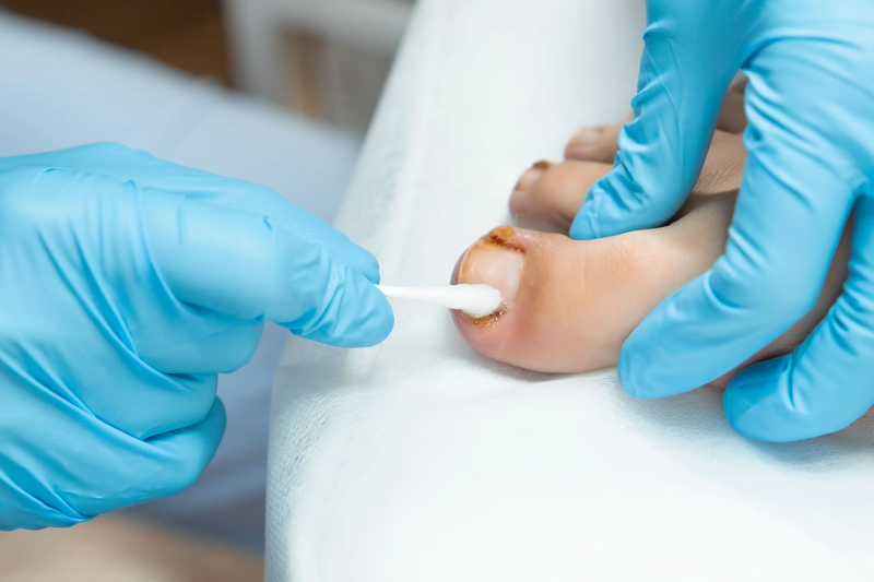 management-for-ingrown-toenails
