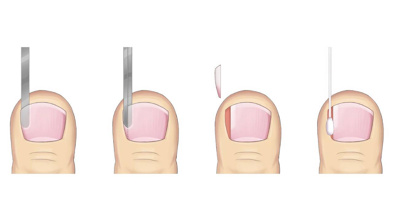 ingrown-toenail-treatment