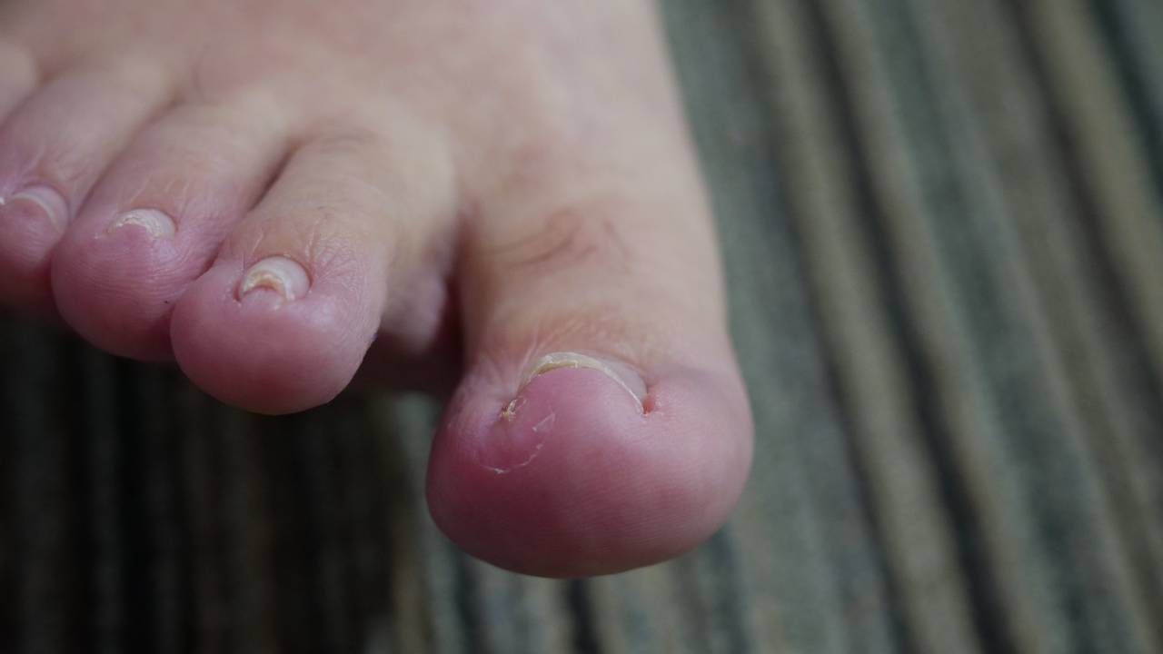 ingrown-toenail