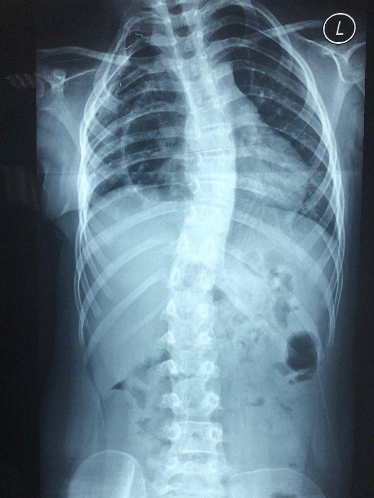 malalignment-syndrome-xray-image