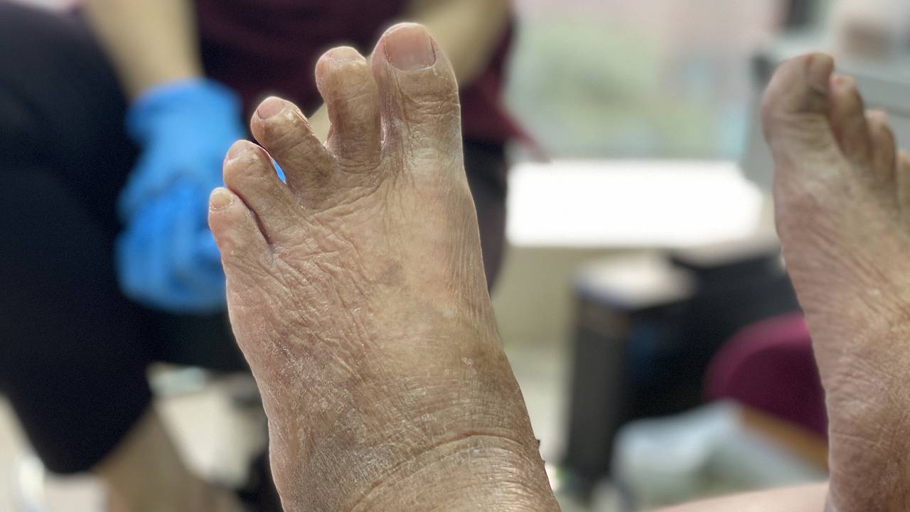 plantar-plate-rupture