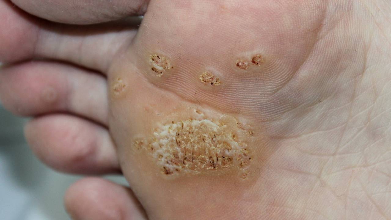 plantar-wart