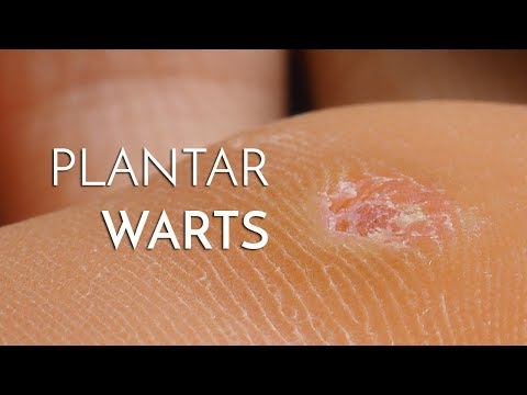 plantar_warts