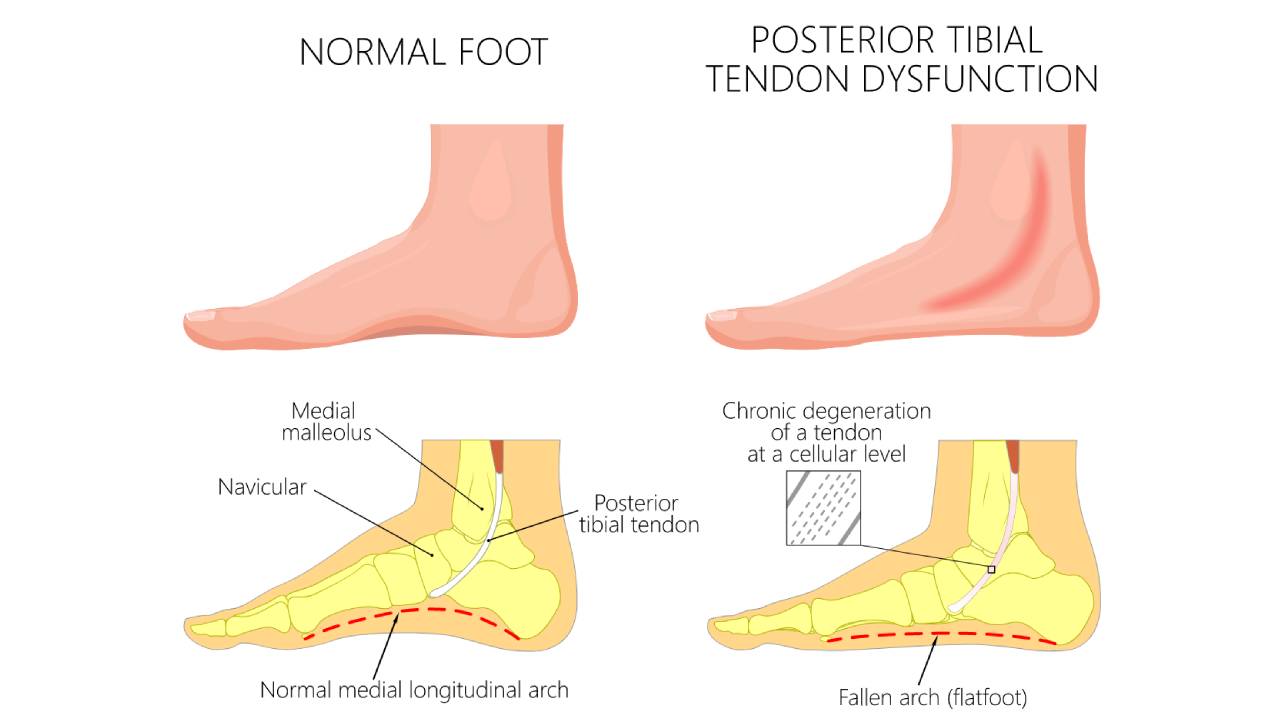posterior-tibial-tendon-dysfunction-diagram