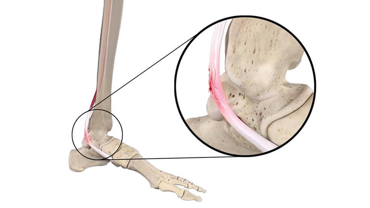 posterior-tibial-tendon-dysfunction-pttd-image-1