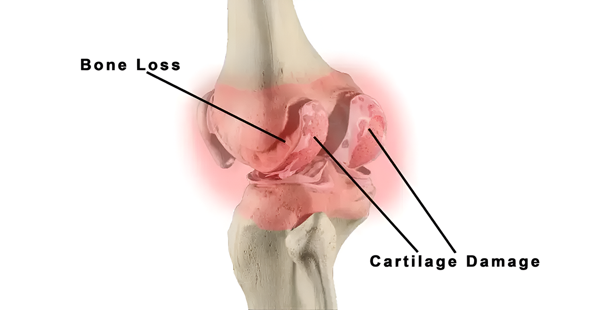 rheumatoid-arthritis-V_01