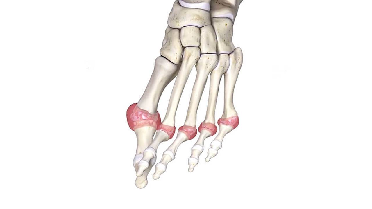 rheumatoid-arthritis-image-1