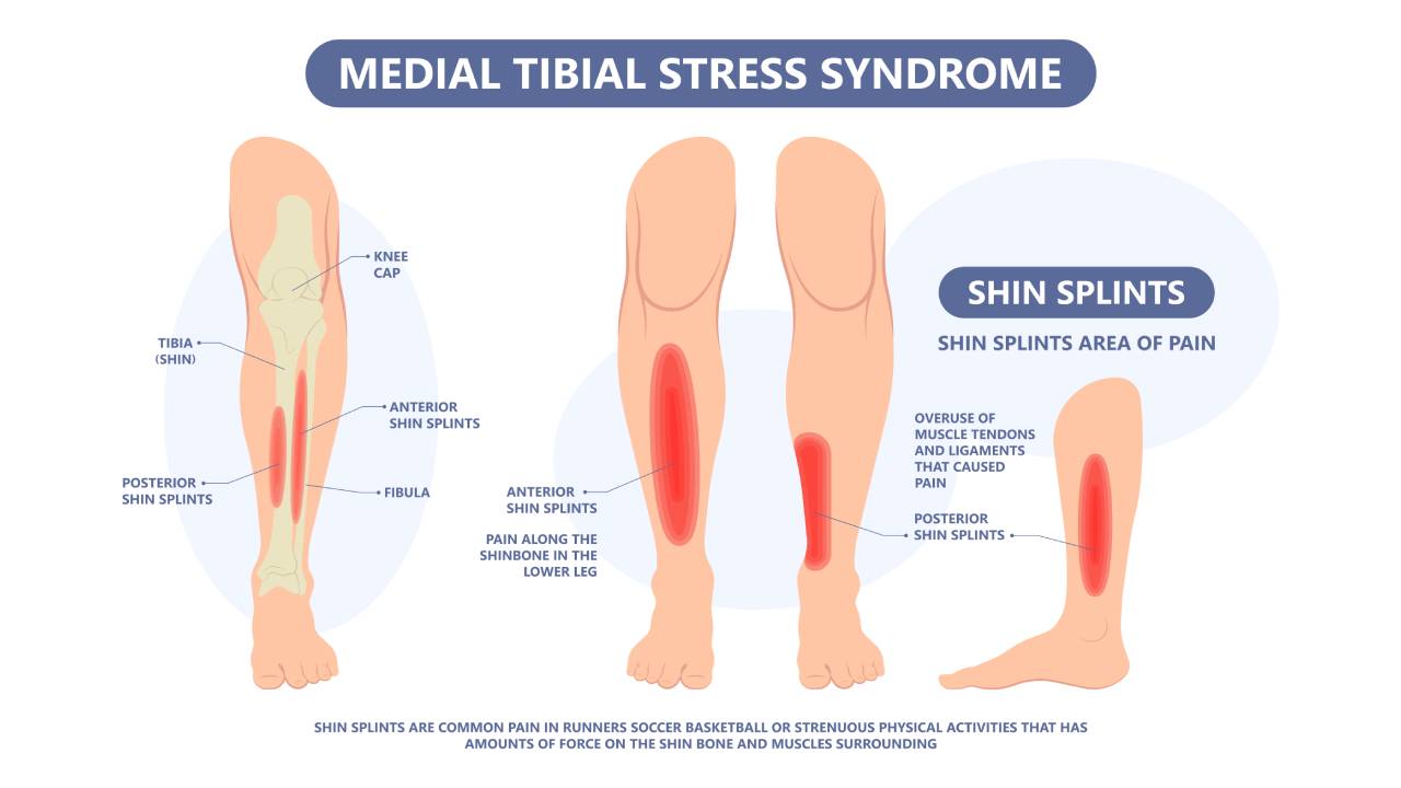 shin-splints-causes