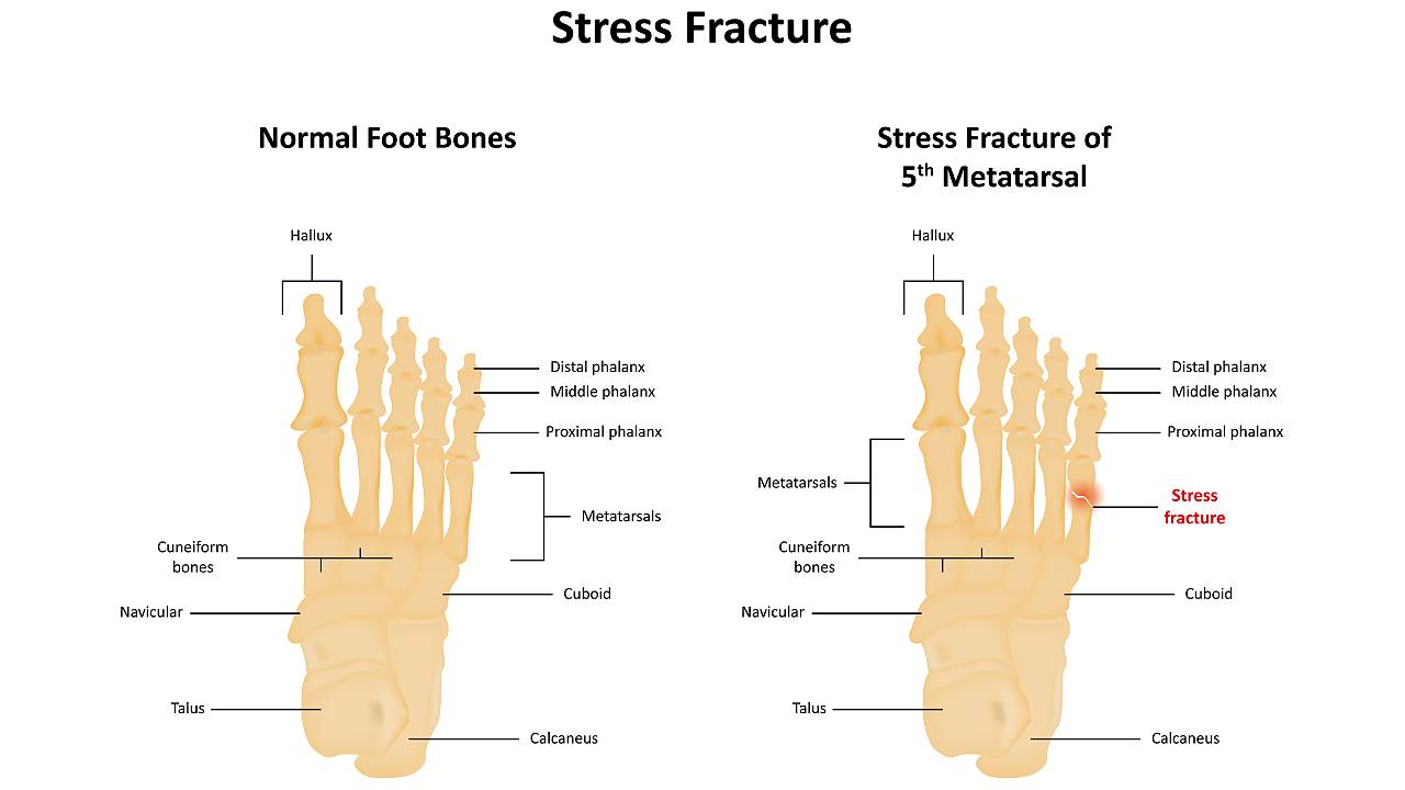 stress-fractures-diagram