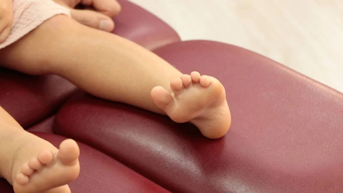 symptoms-of-metatarsus-adductus (1)