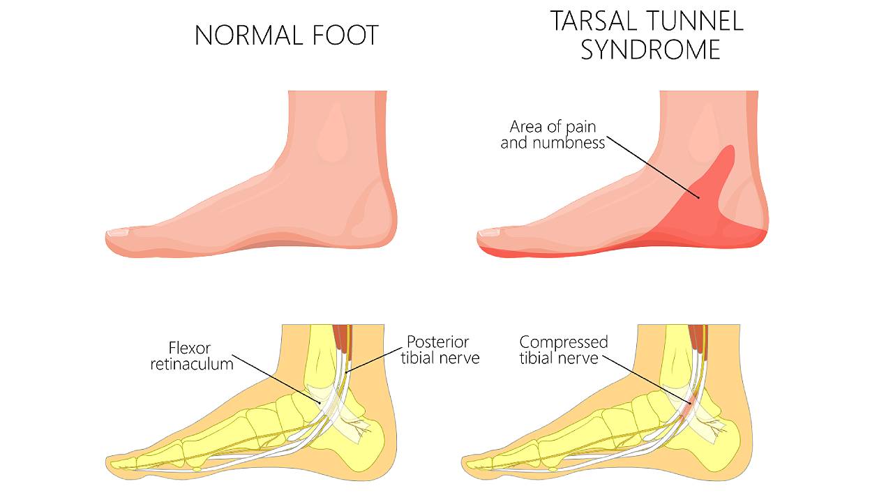 tarsal-tunnel-syndrome-symptoms