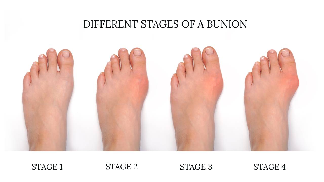 toe-bunion