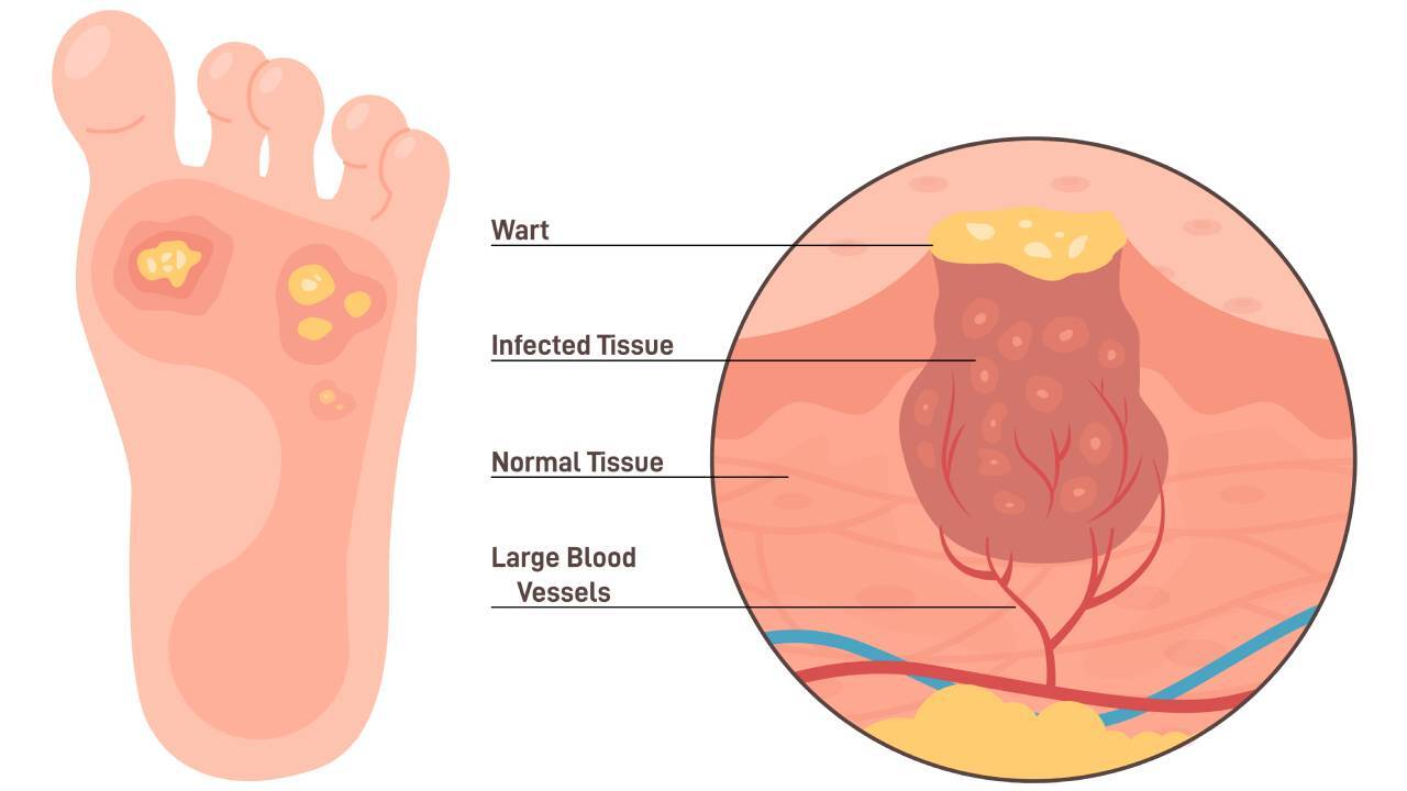 wart-on-foot