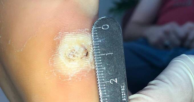 wart-treatments-thumbnail 