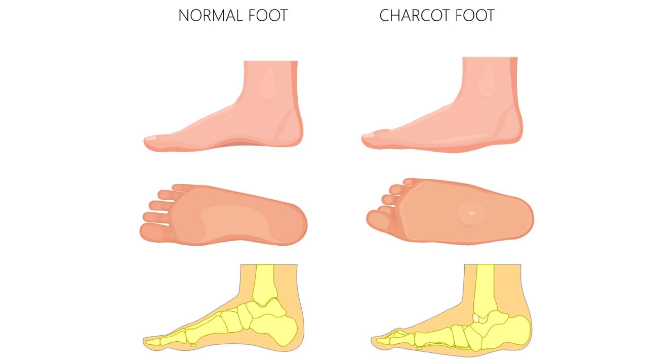 what-is-charcot-foot