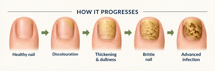 Fungal Toenail Progression Illustration