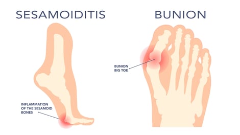 Sesamoiditis vs Bunion Pain: Why It Matters to Know the Difference