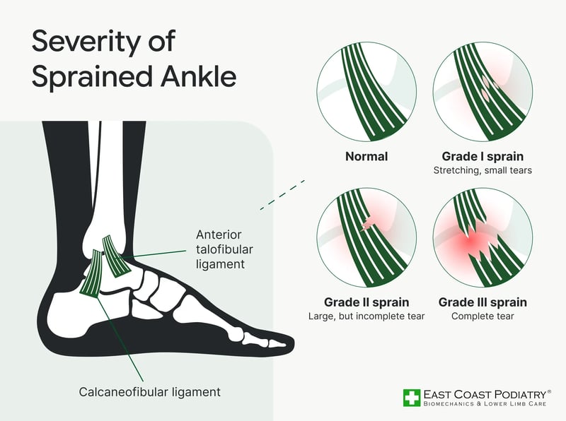 Severity of Sprained Ankle