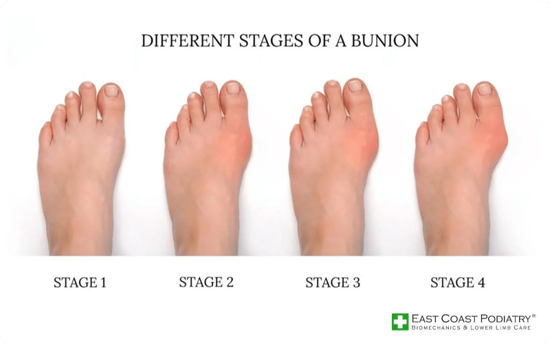 Stages of a bunion East Coast