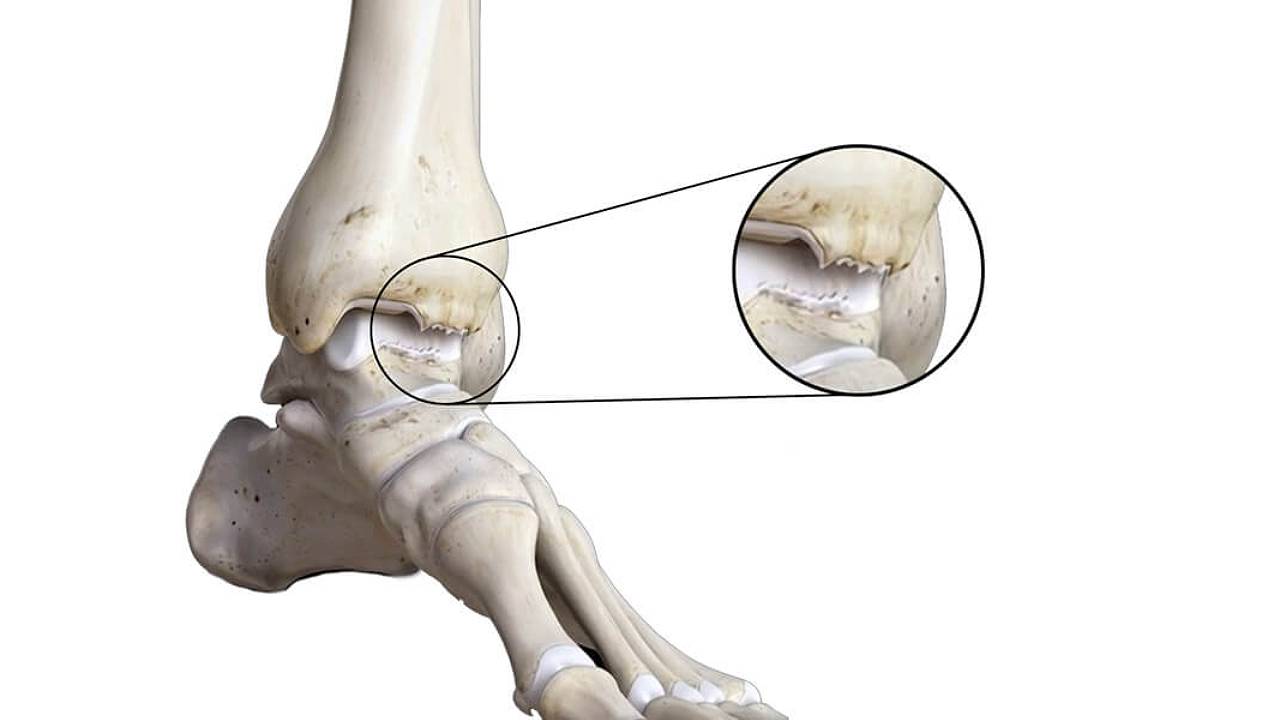 arthritis-of-the-foot-and-ankle-image-2