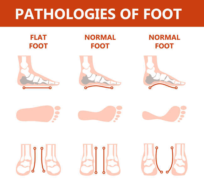 flat-feet-flat-foot-size-1