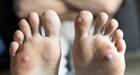 How to Spot and Prevent Plantar Warts: A Practical Guide for Healthier Feet