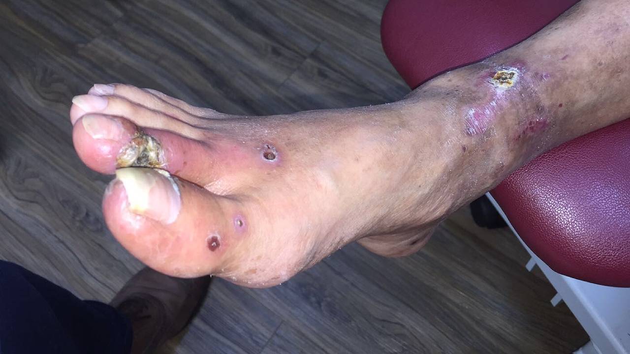 pvd-pad-gangrene-image-1