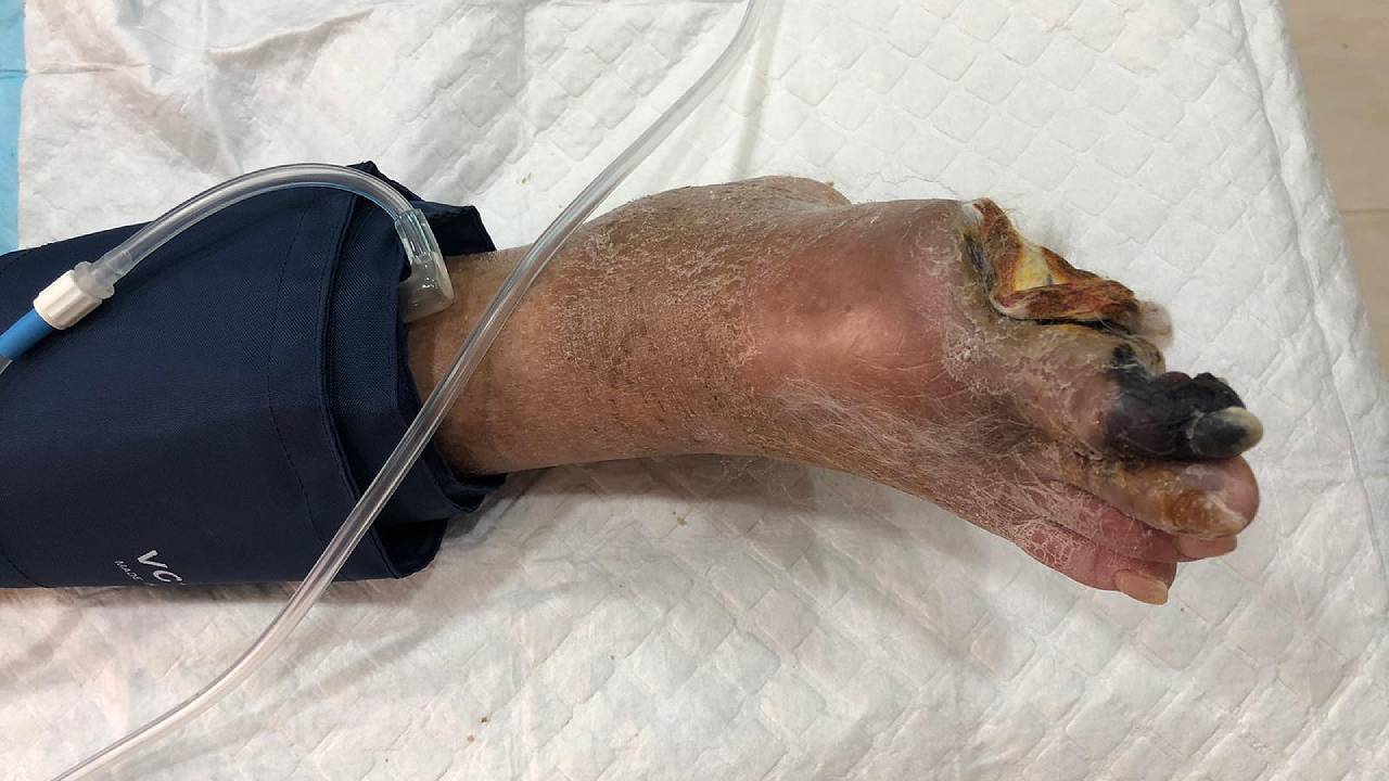 pvd-pad-gangrene-image-3