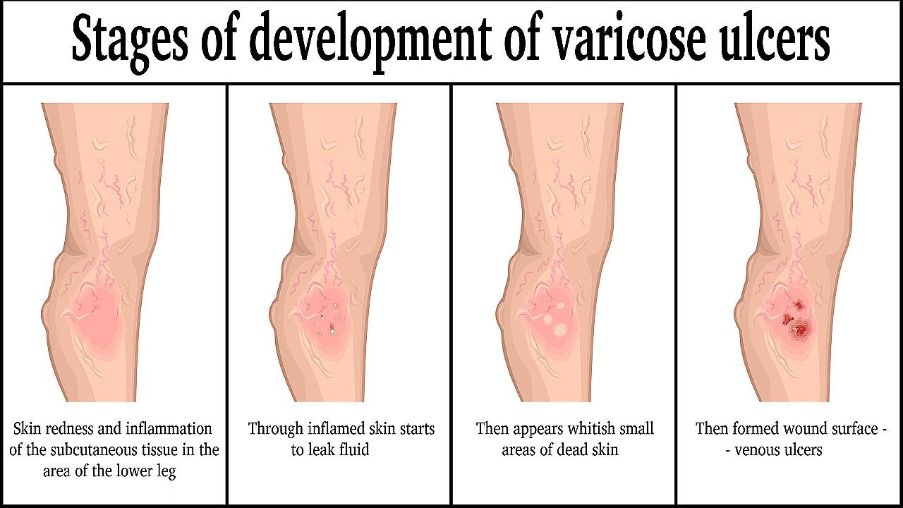 venous-insufficiency-stasis-and-ulceration-image-1