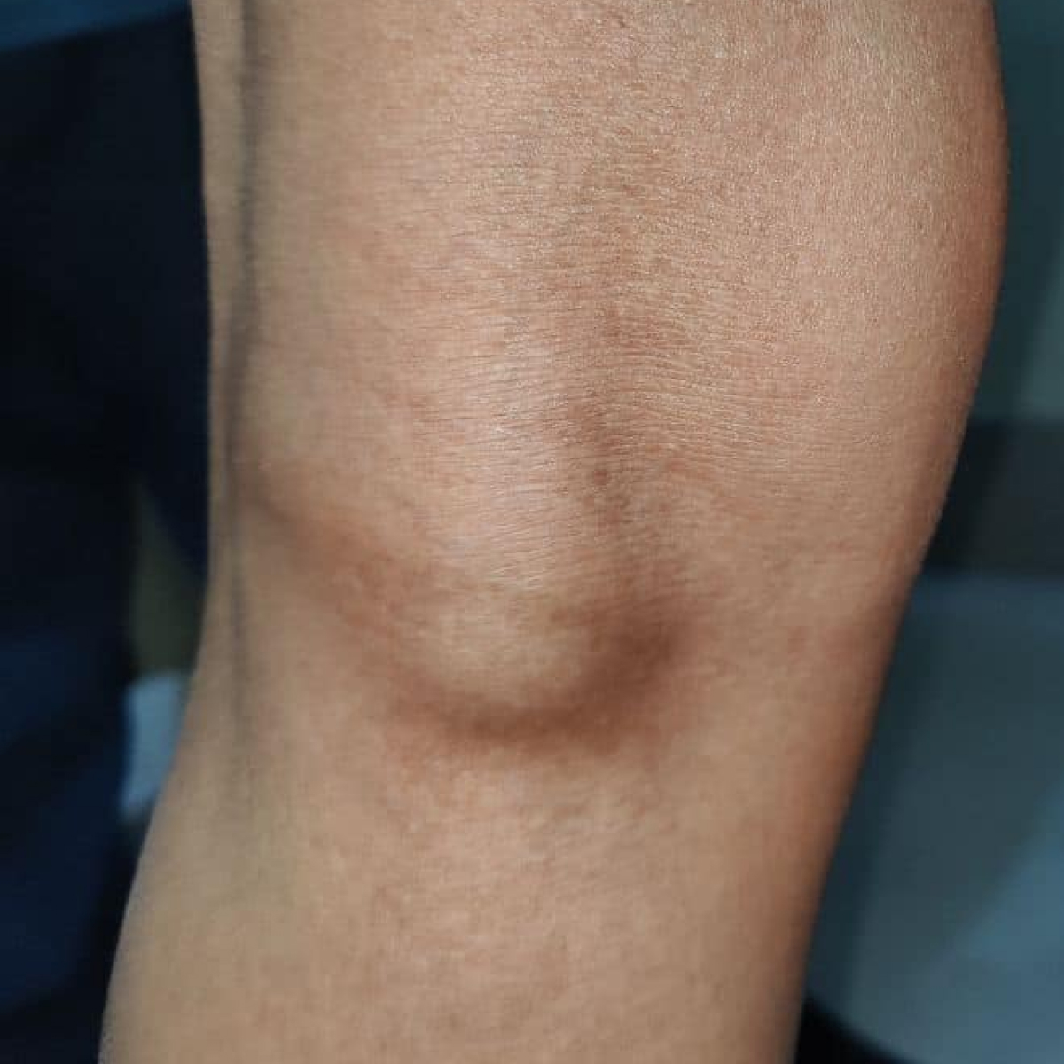 Baker’s Cyst