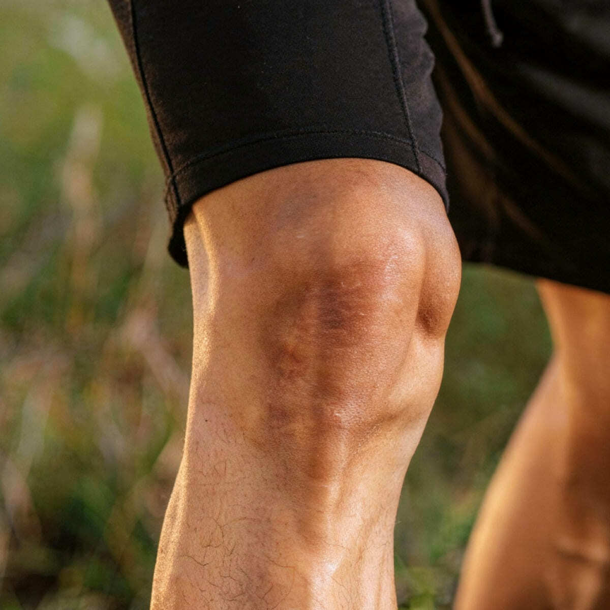 Dislocated Kneecap (1)