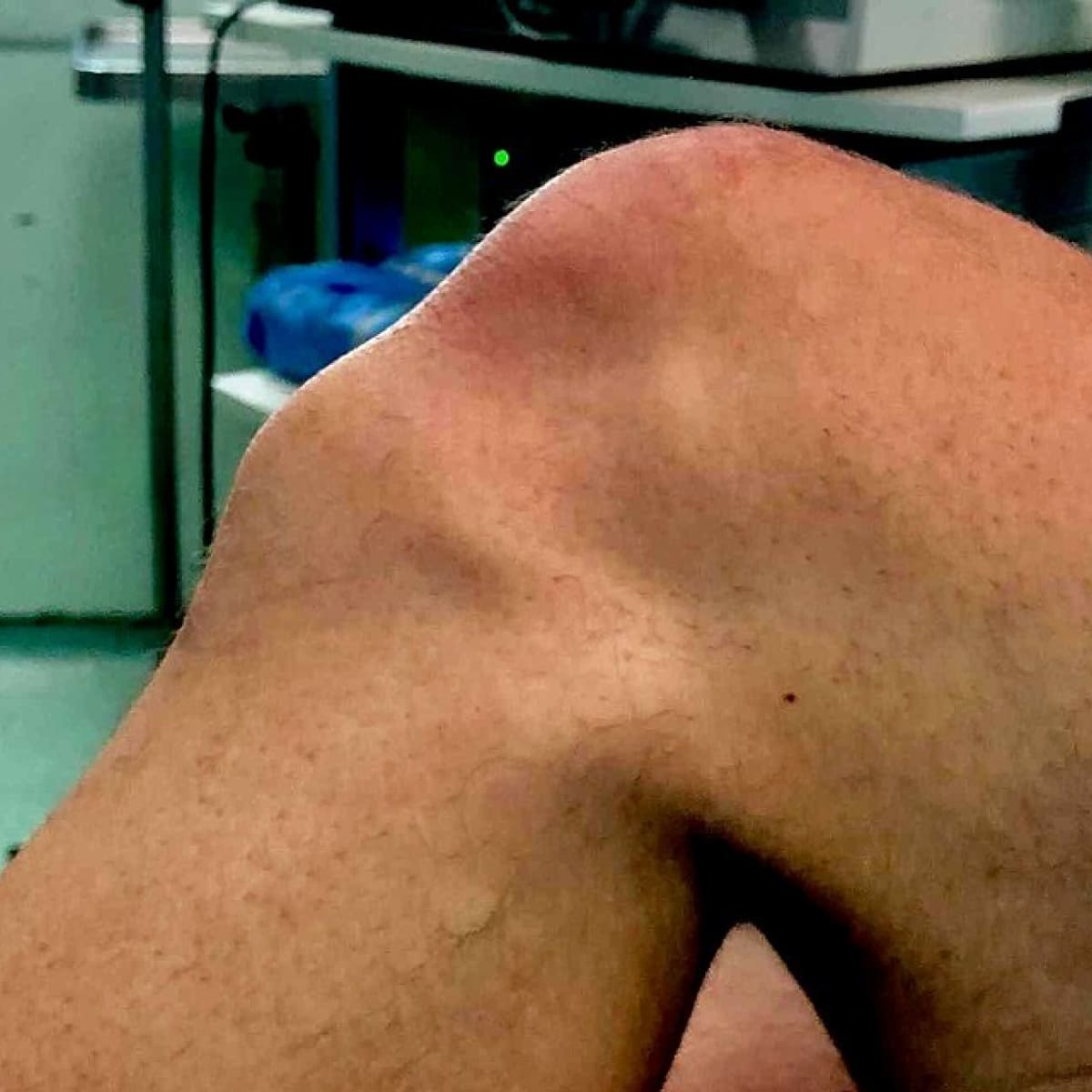 Osgood-Schlatter Disease (1)