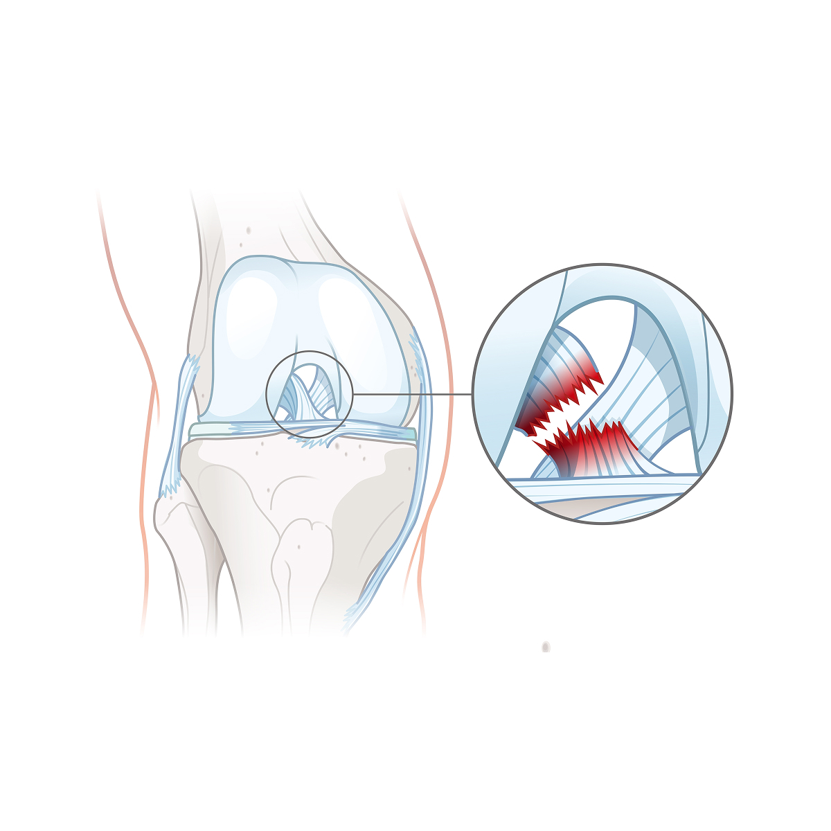 Sprain or Strained Ligaments02