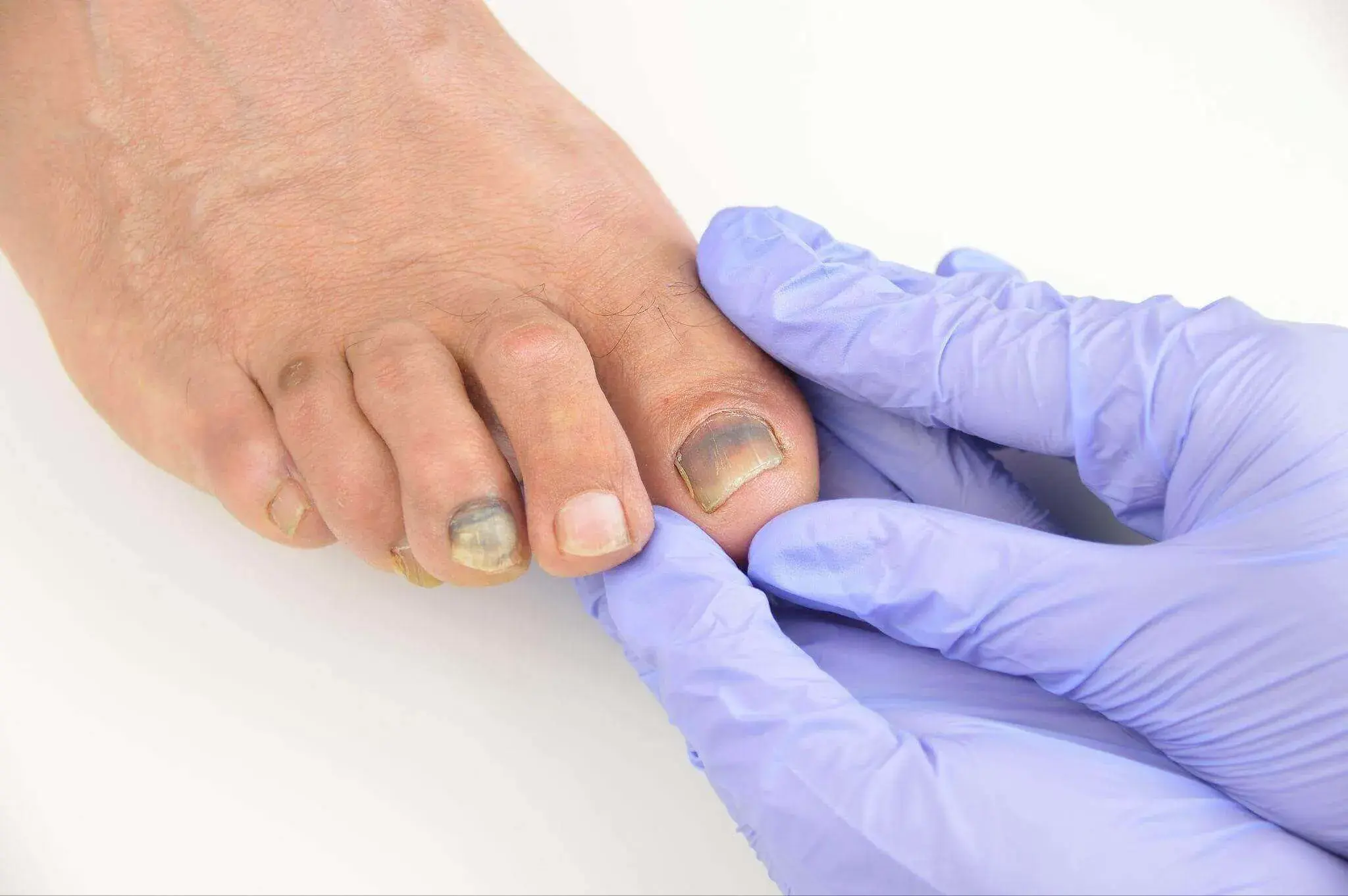 10 Tips to Manage Toenail Trauma and Keep Your Feet Safe