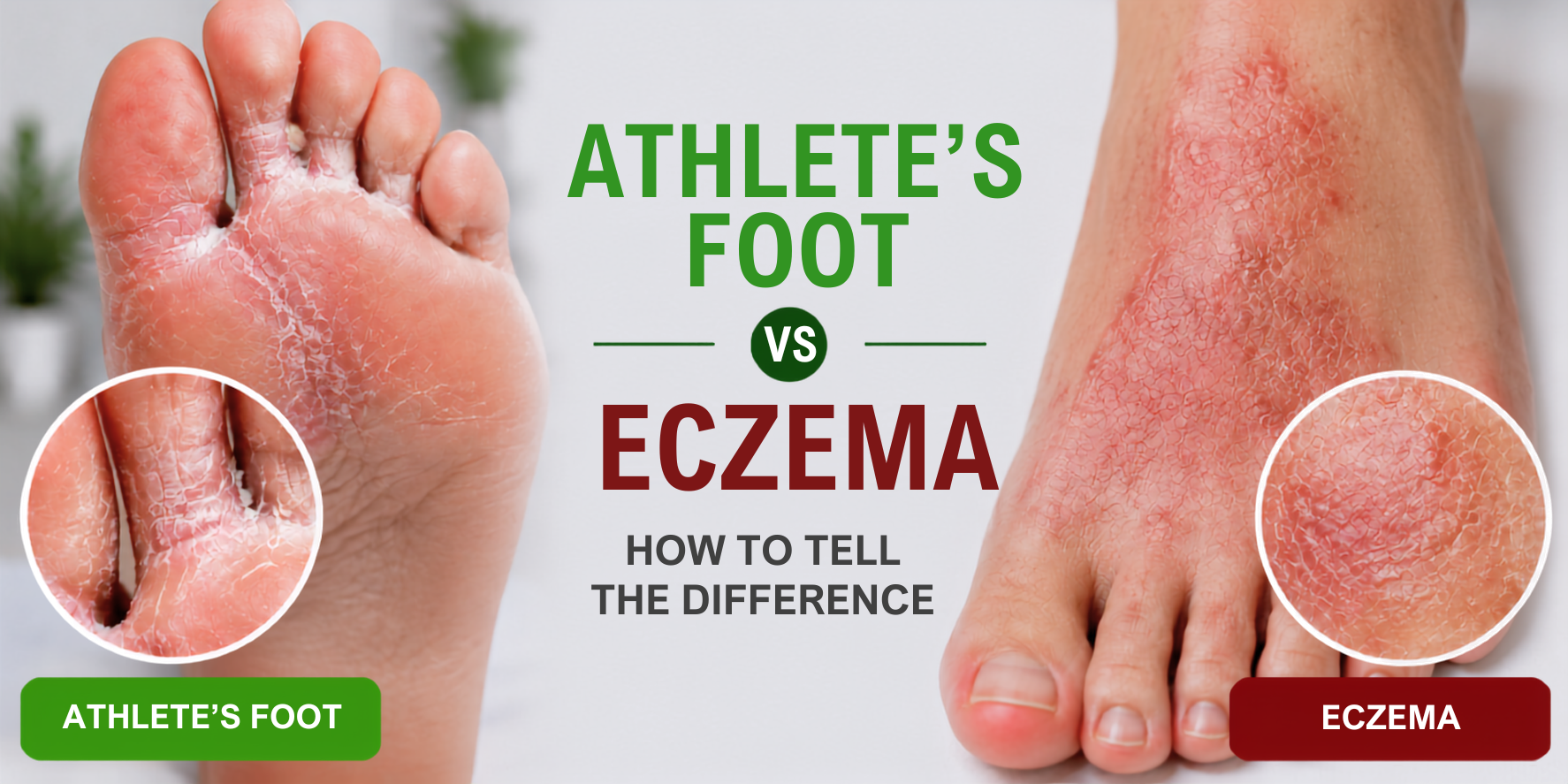 Athlete's Foot vs Eczema: How to Tell the Difference