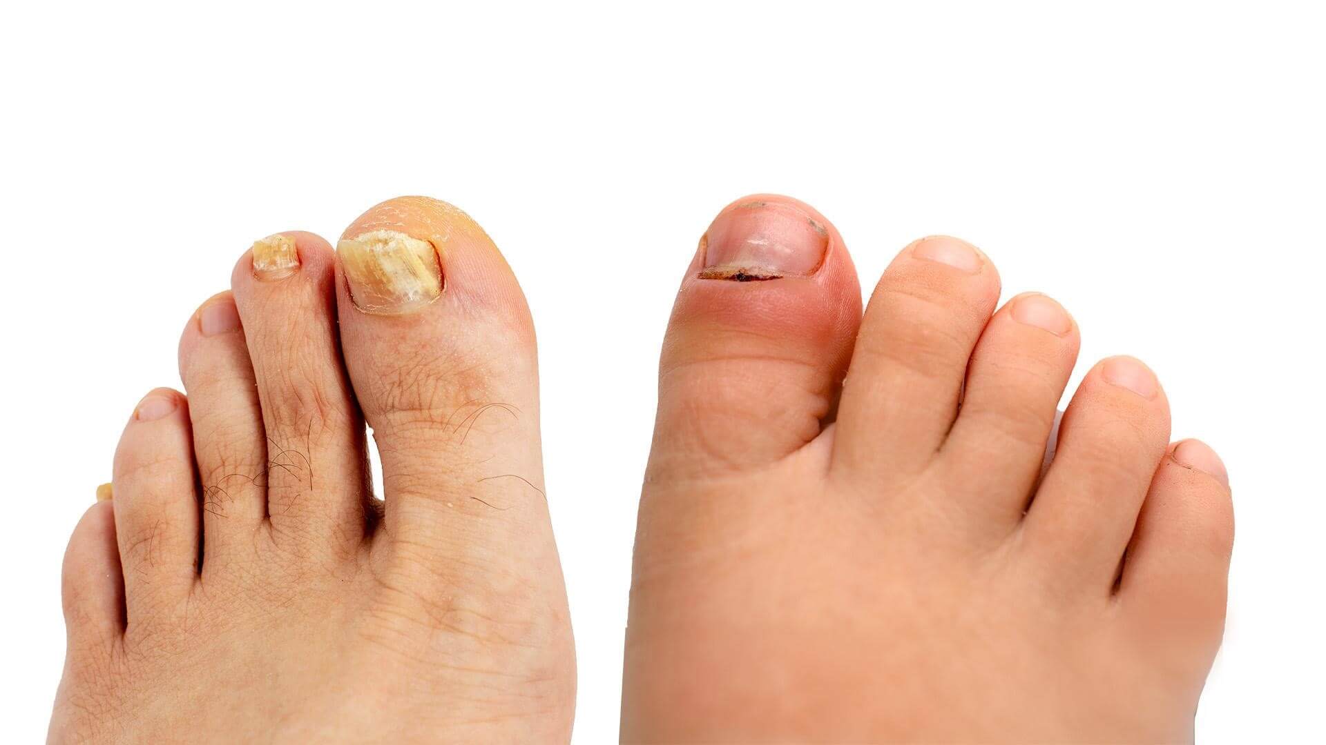 Fungal Toenail vs Paronychia: Know the Key Differences