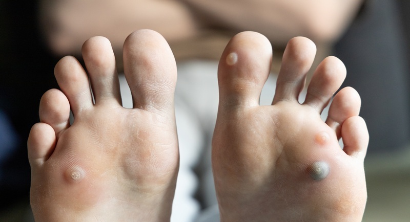 How to Spot and Prevent Plantar Warts: A Practical Guide for Healthier Feet