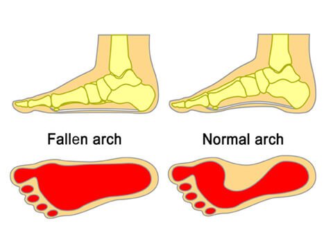 shoe sole for flat feet