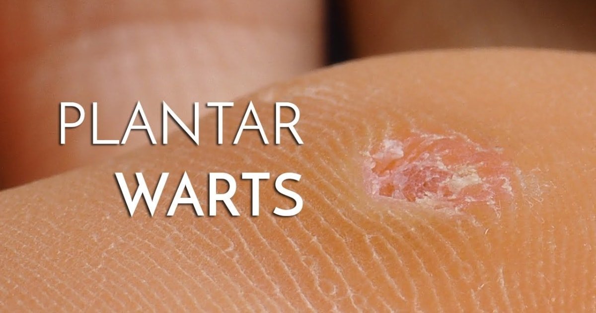 Foot Clinic in Singapore | Podiatry Clinic for Plantar Warts Removal