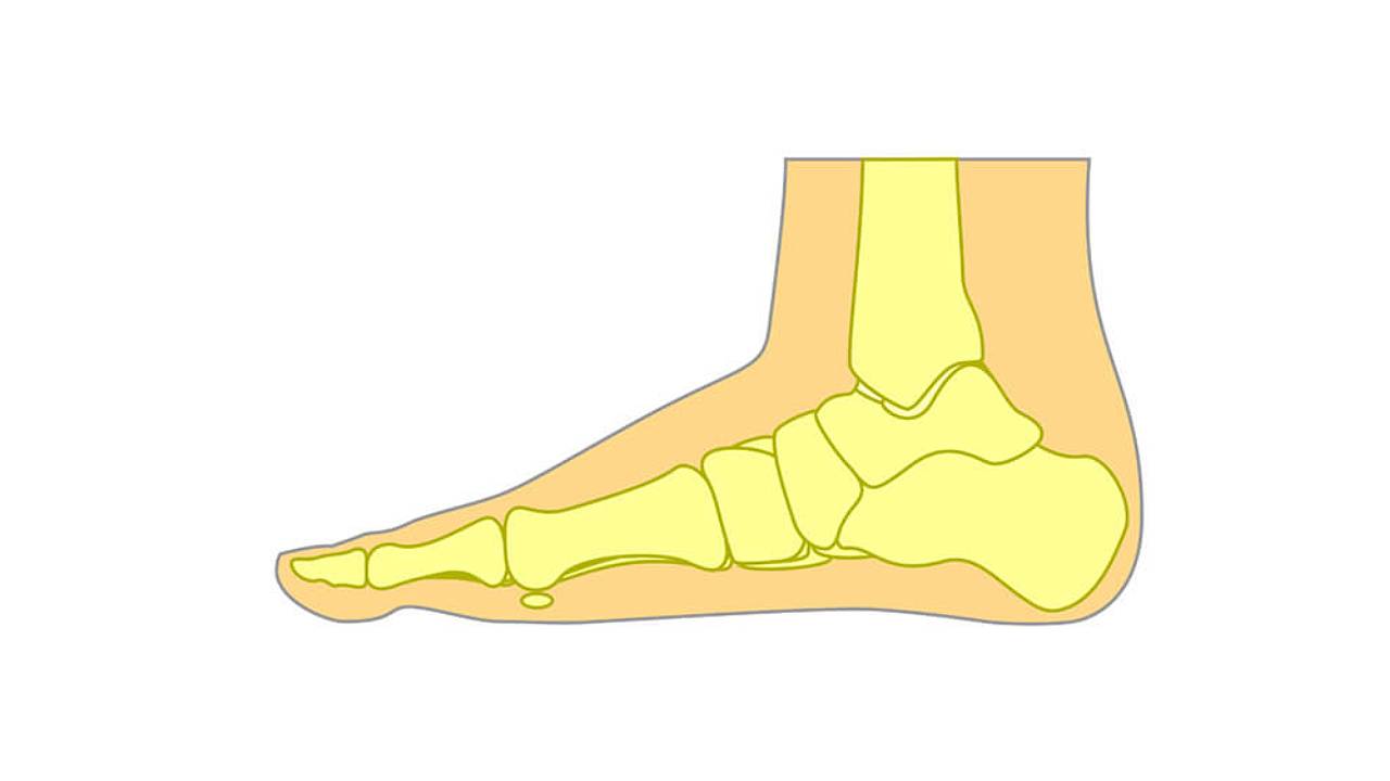 Low arch, flat foot
