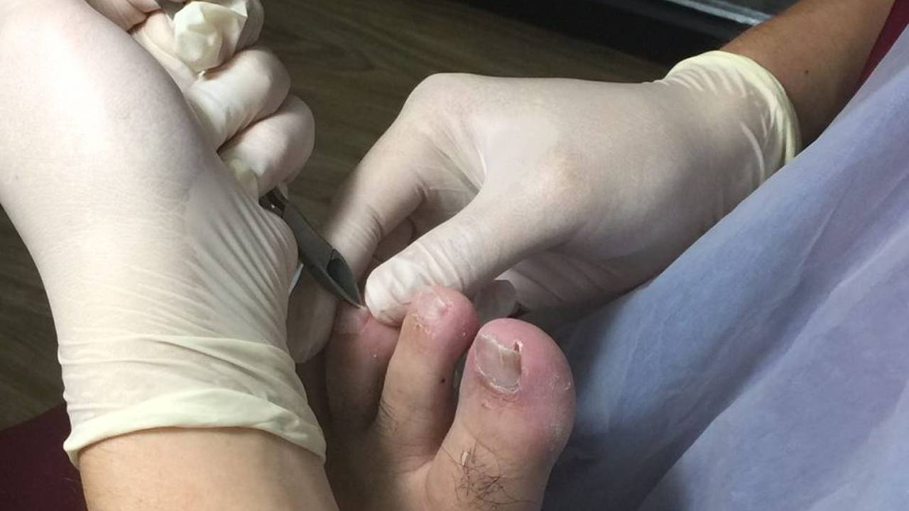 Podiatrist remove ingrown nails