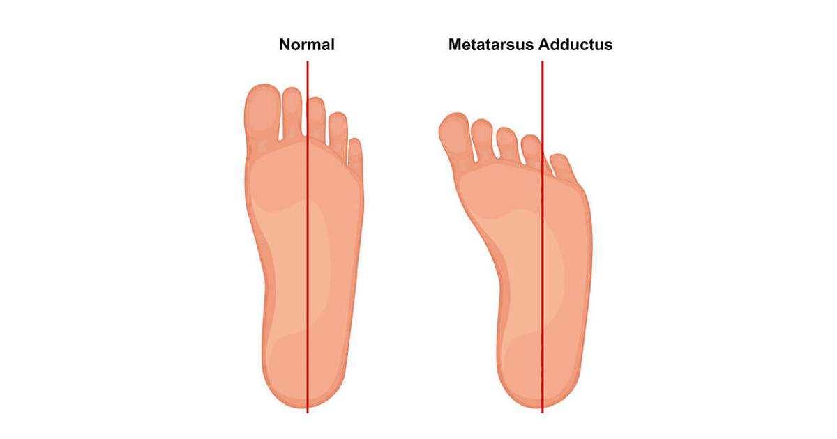 ECP | Metatarsus Adductus Compare Normal Feet