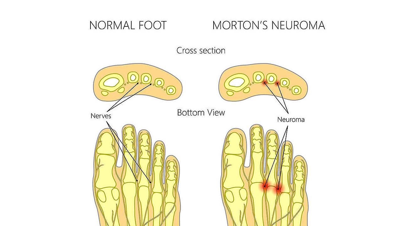 Morton Neuroma Comparison between Normal Foot