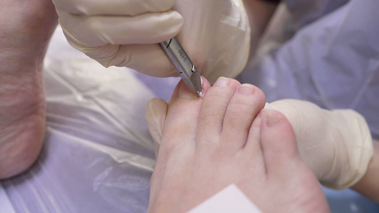 ECP | Ingrown Toe Nail Treatment