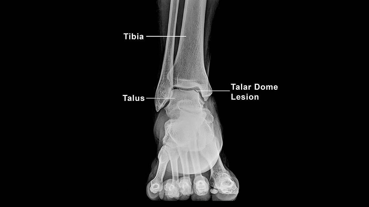 Talar Dome Injuries | Skeleton View showing Talar Dome Lesion