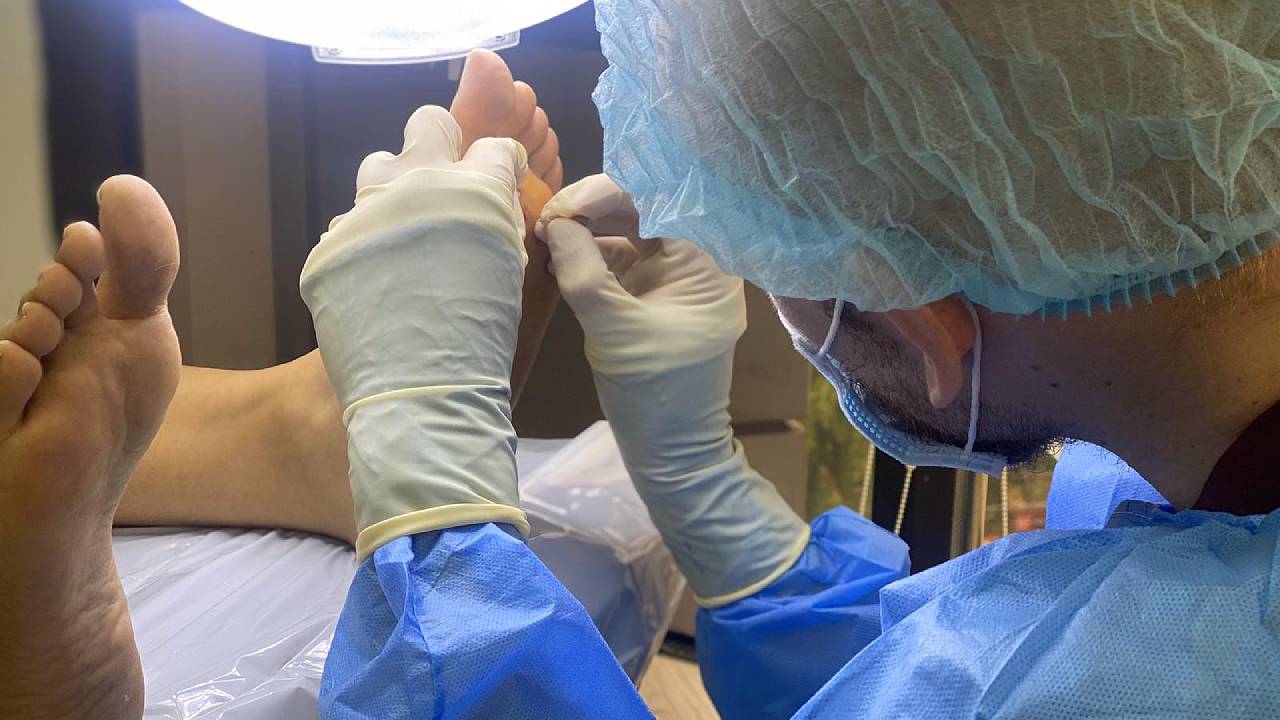 Elliot needling wart in clinic treatment surgery procedure